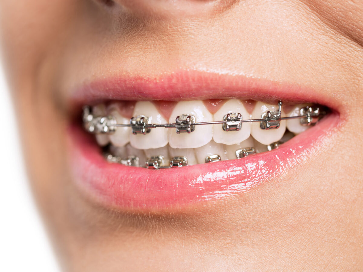 Do Braces Make Your Lips Bigger 