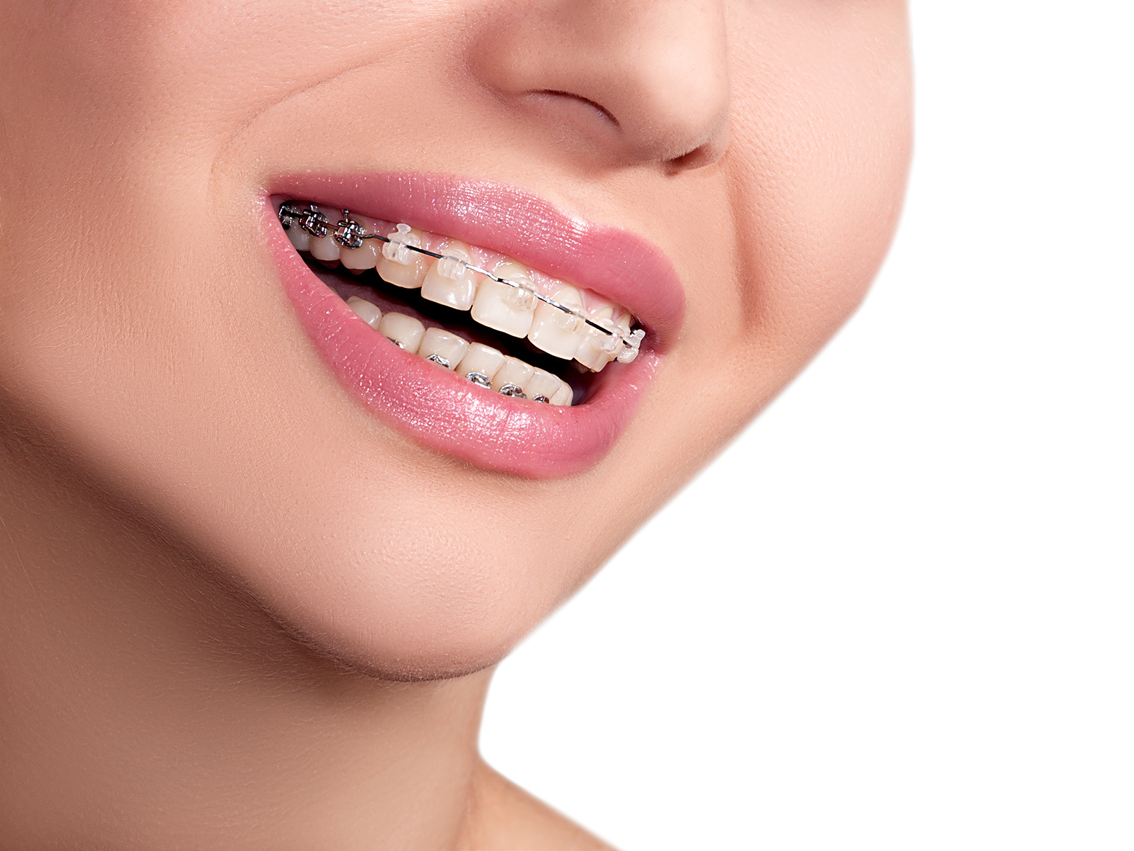 What happens if your braces don’t get tightened?