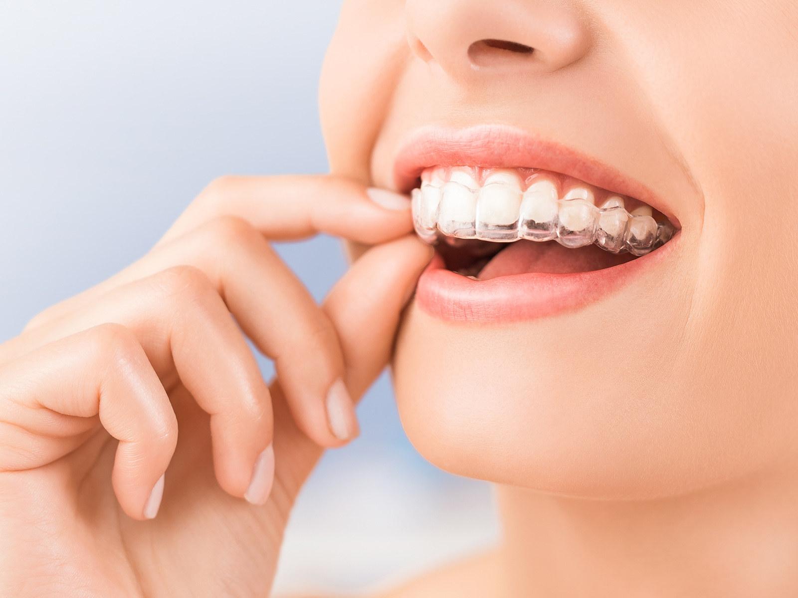 How long do 19 trays of Invisalign take?