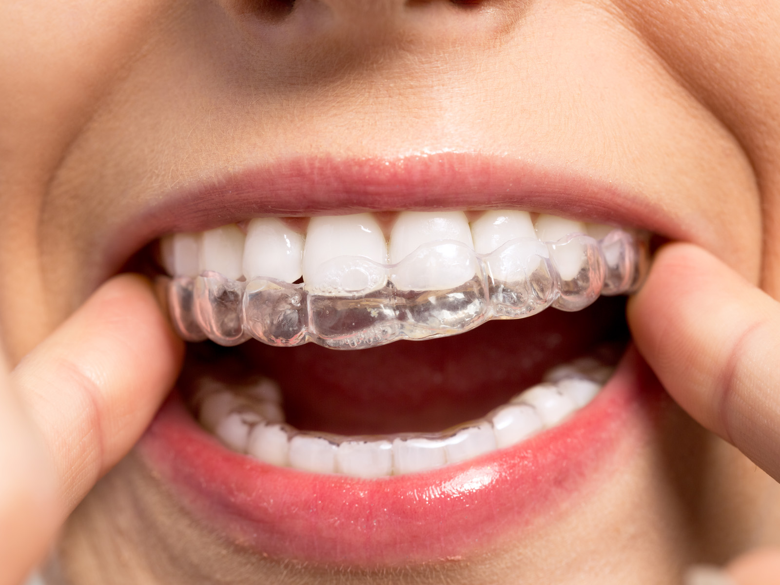Can you eat with Invisalign?