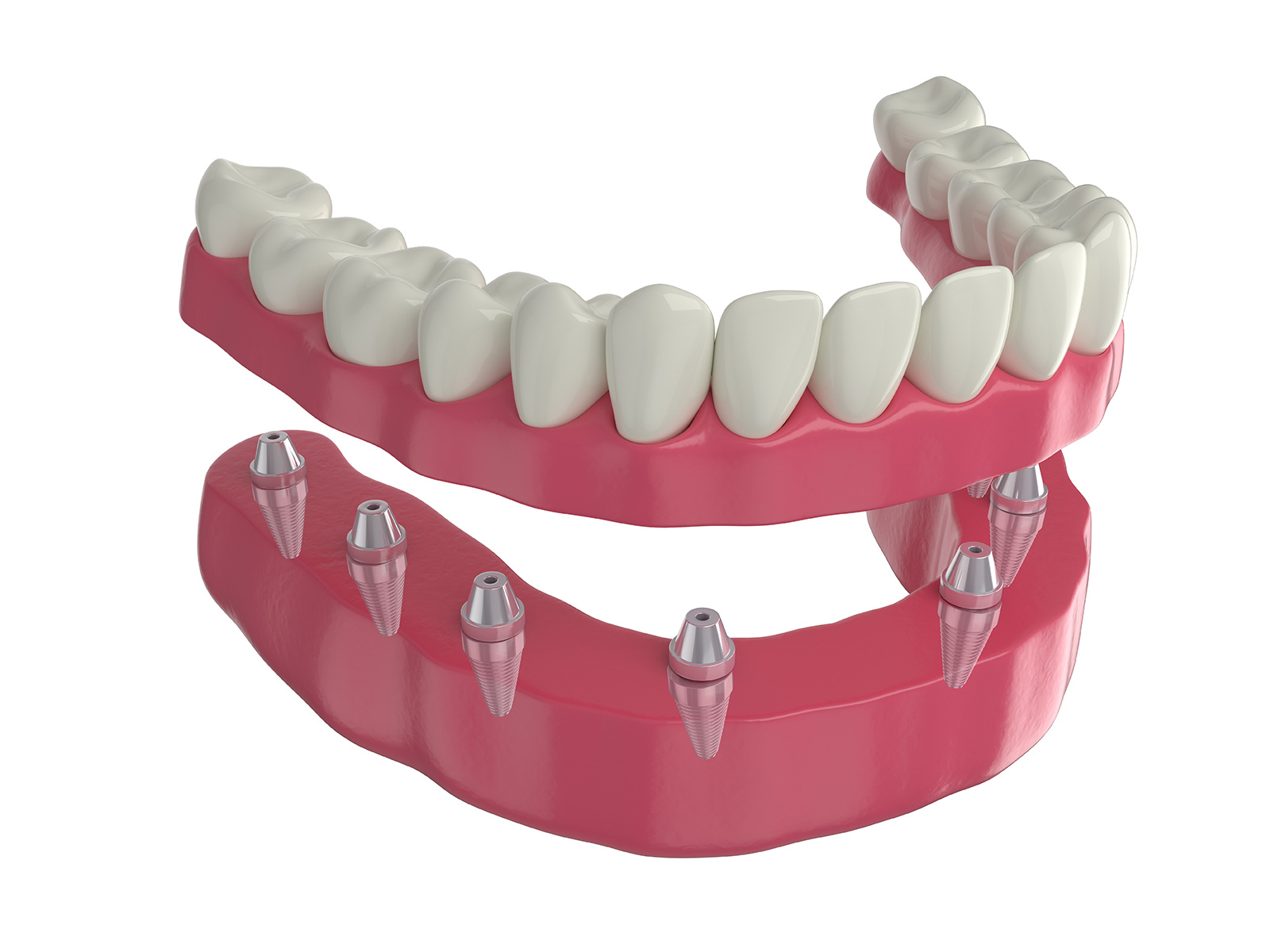 What Are The Problems With Implant Retained Dentures?