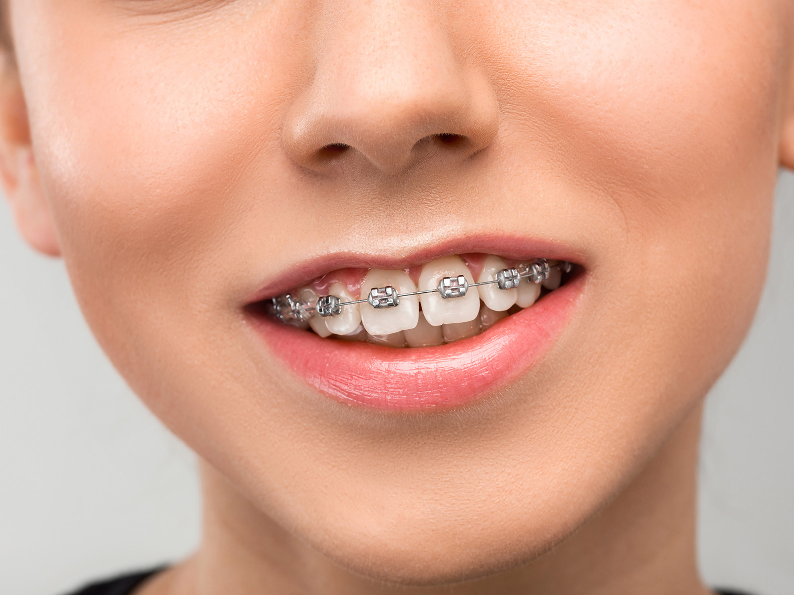 What Are Some Common Tips To Prevent Ceramic Braces From Staining?