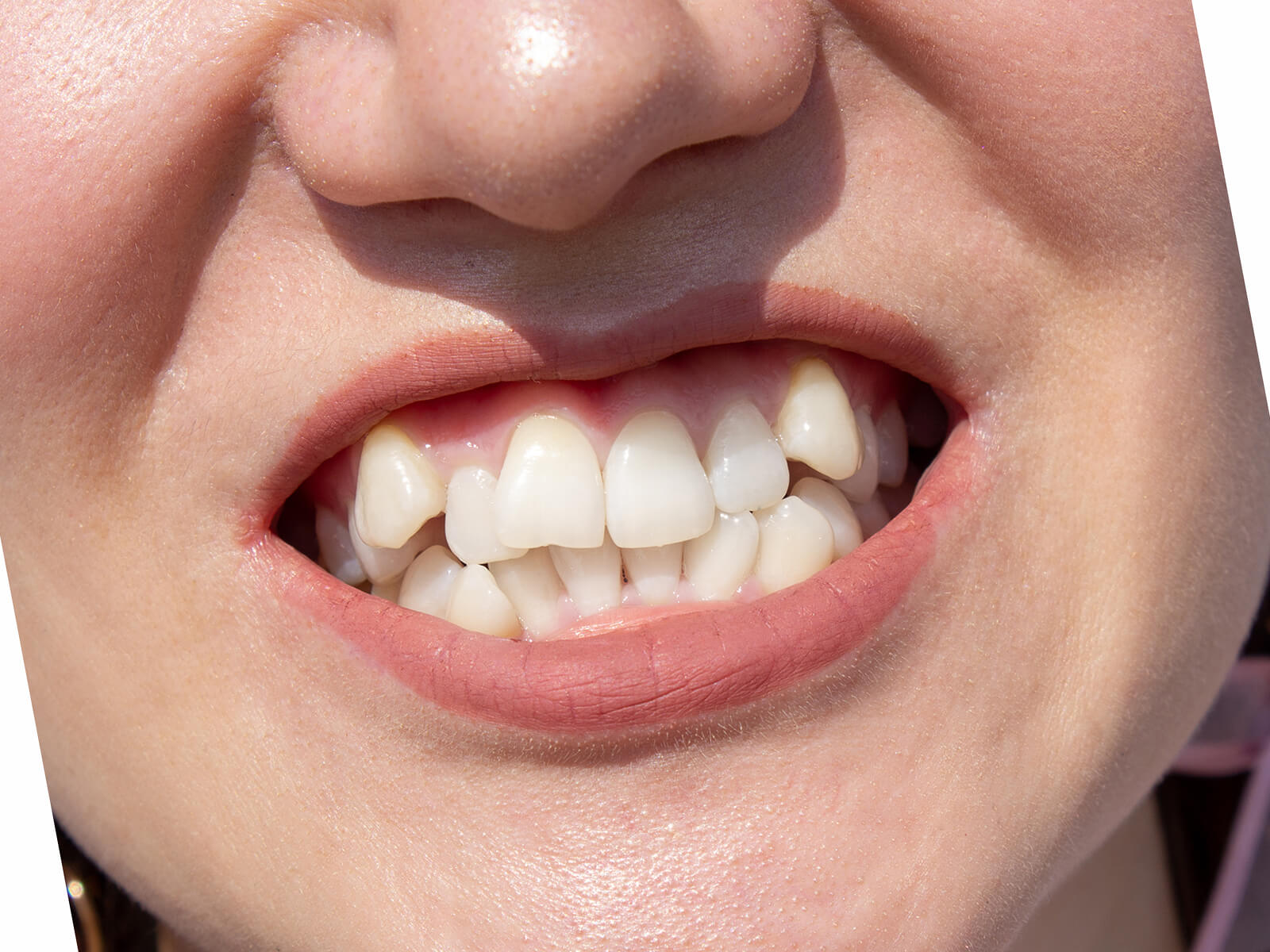 Teeth Shifting: Signs Your Teeth Are Shifting