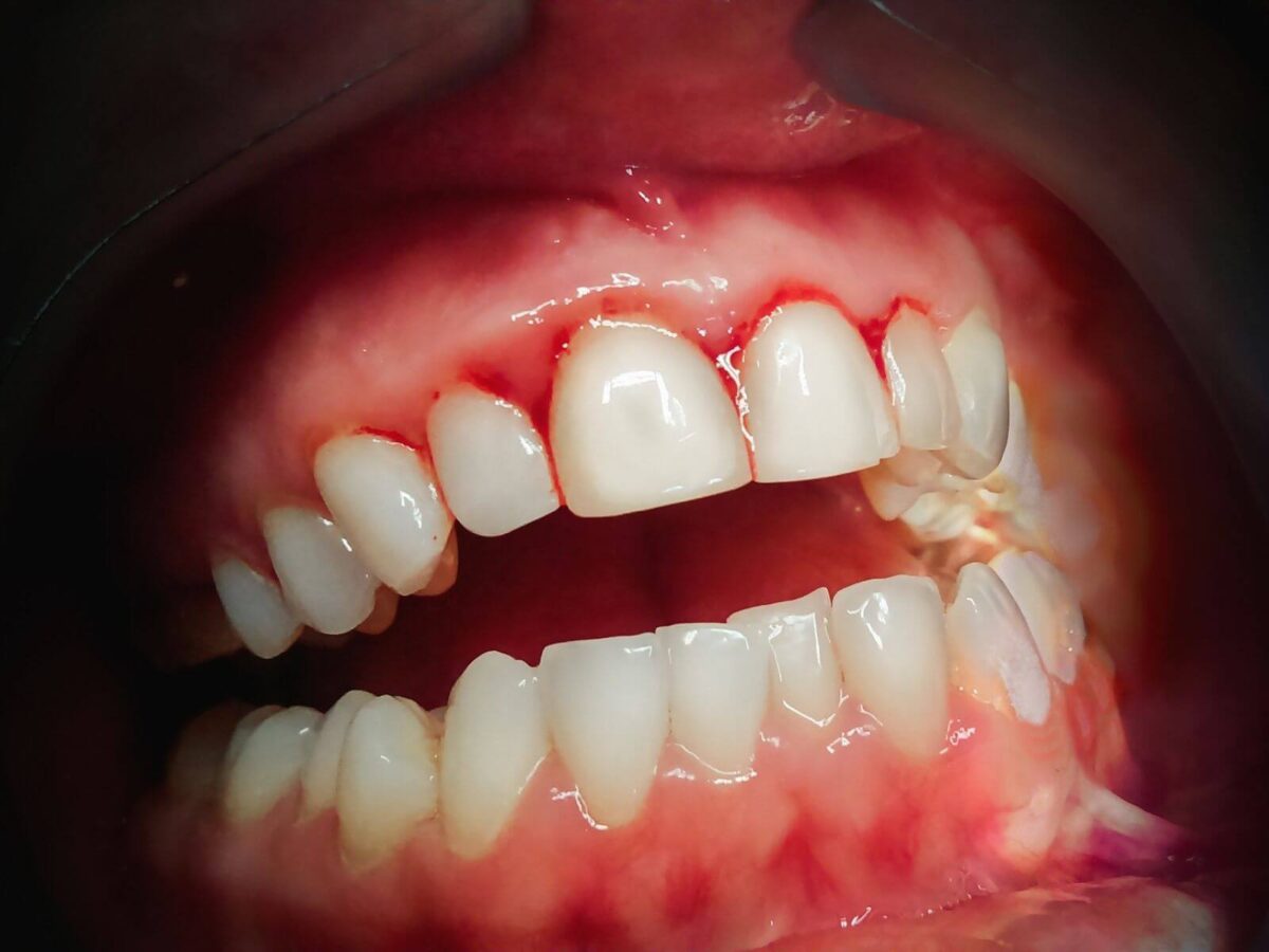 The Hidden Dangers of Tobacco on Your Teeth And Gums