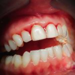 The Hidden Dangers of Tobacco on Your Teeth And Gums