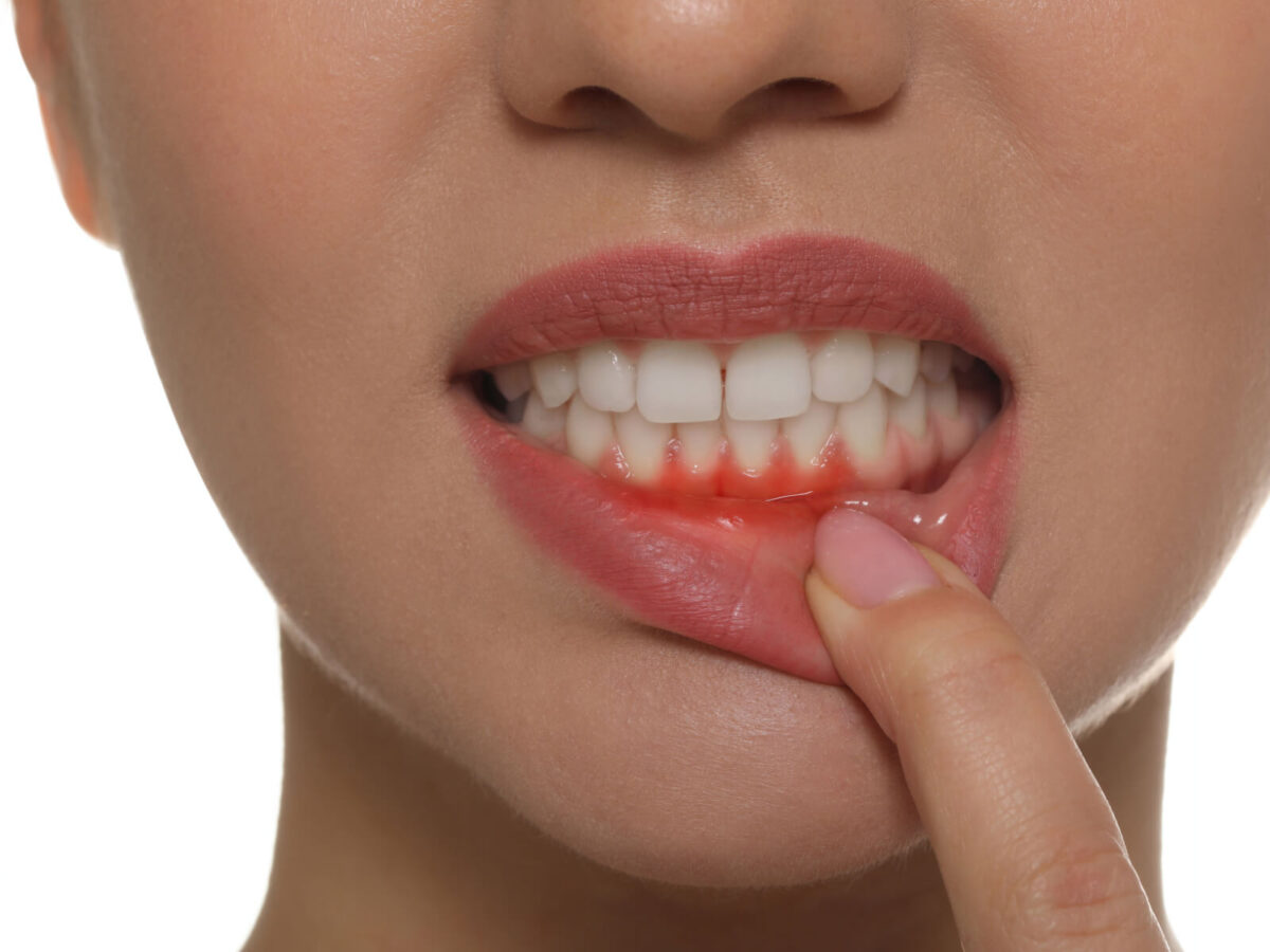 How To Prevent Receding Gums: Essential Tips For Gum Health