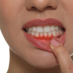 How To Prevent Receding Gums: Essential Tips For Gum Health
