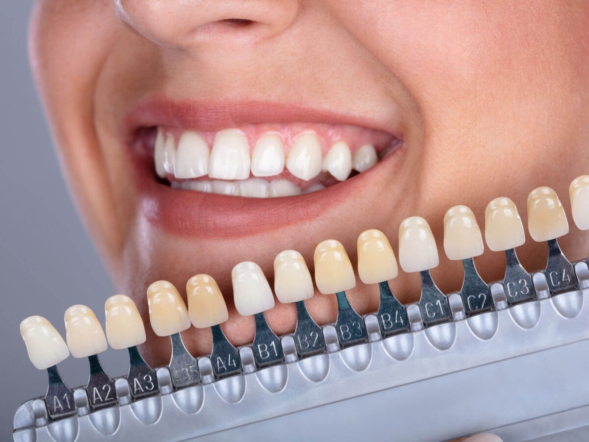 The Benefits of Professional Teeth Whitening Over At-Home Kits