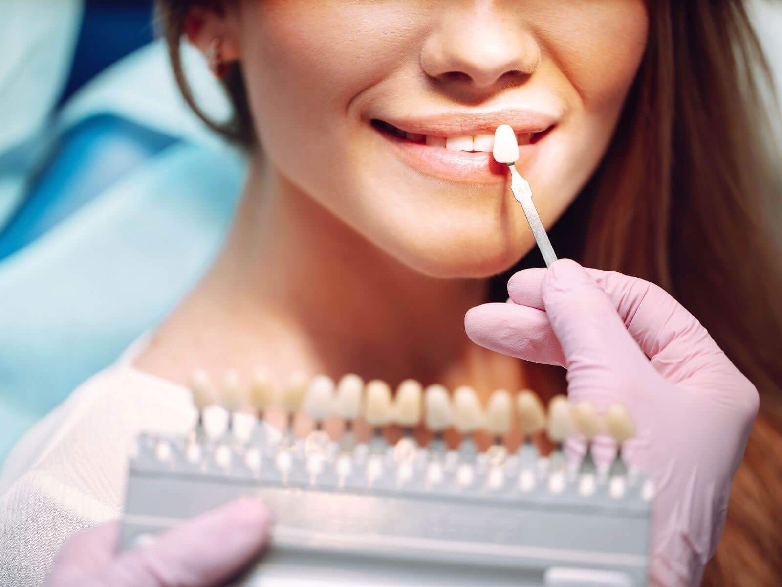 How Long Do Dental Veneers Last?