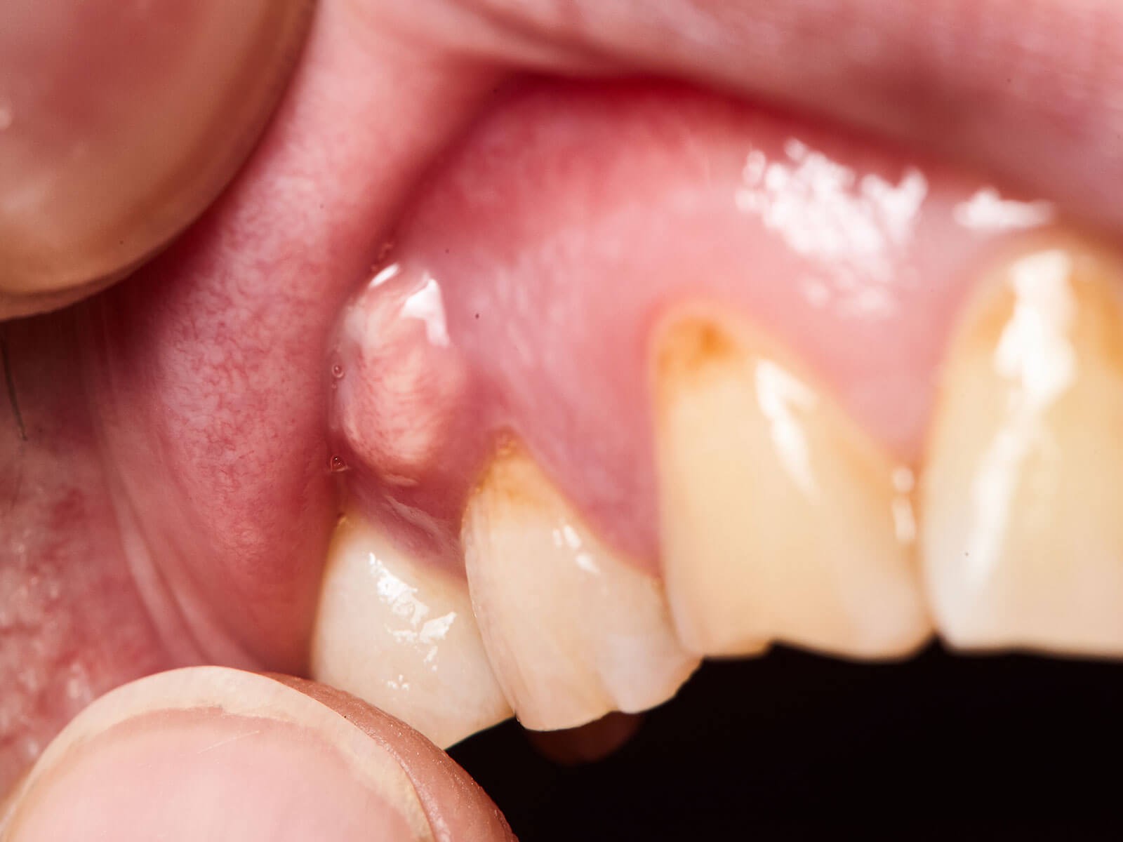 Tooth Abscess: Warning Signs, Common Causes & Treatment Options