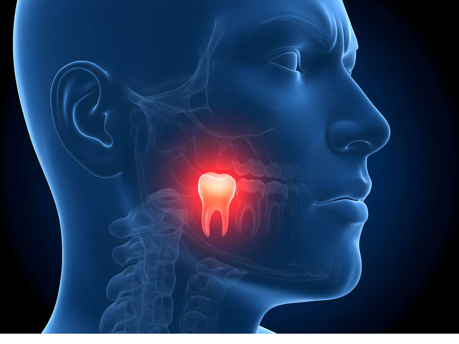 Impacted vs Erupted Wisdom Tooth