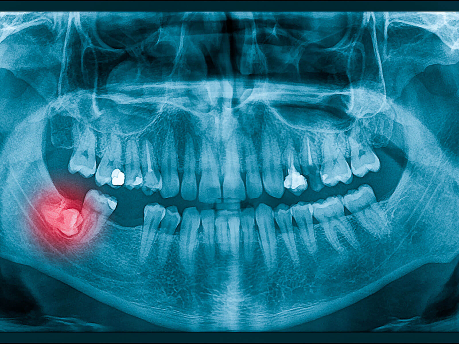 Impacted Wisdom Tooth: Meaning, Symptoms, and Treatment