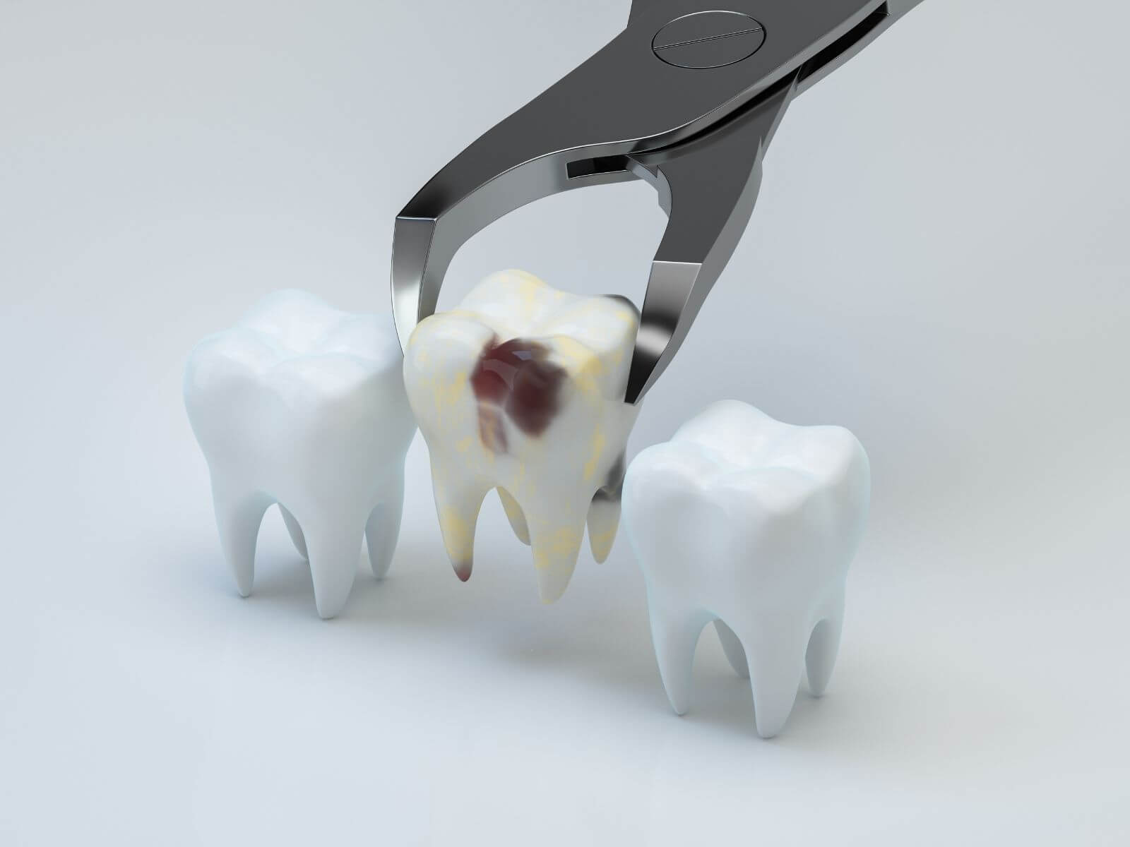 Same-Day Tooth Extraction and Implant: Process, Candidacy, and Recovery